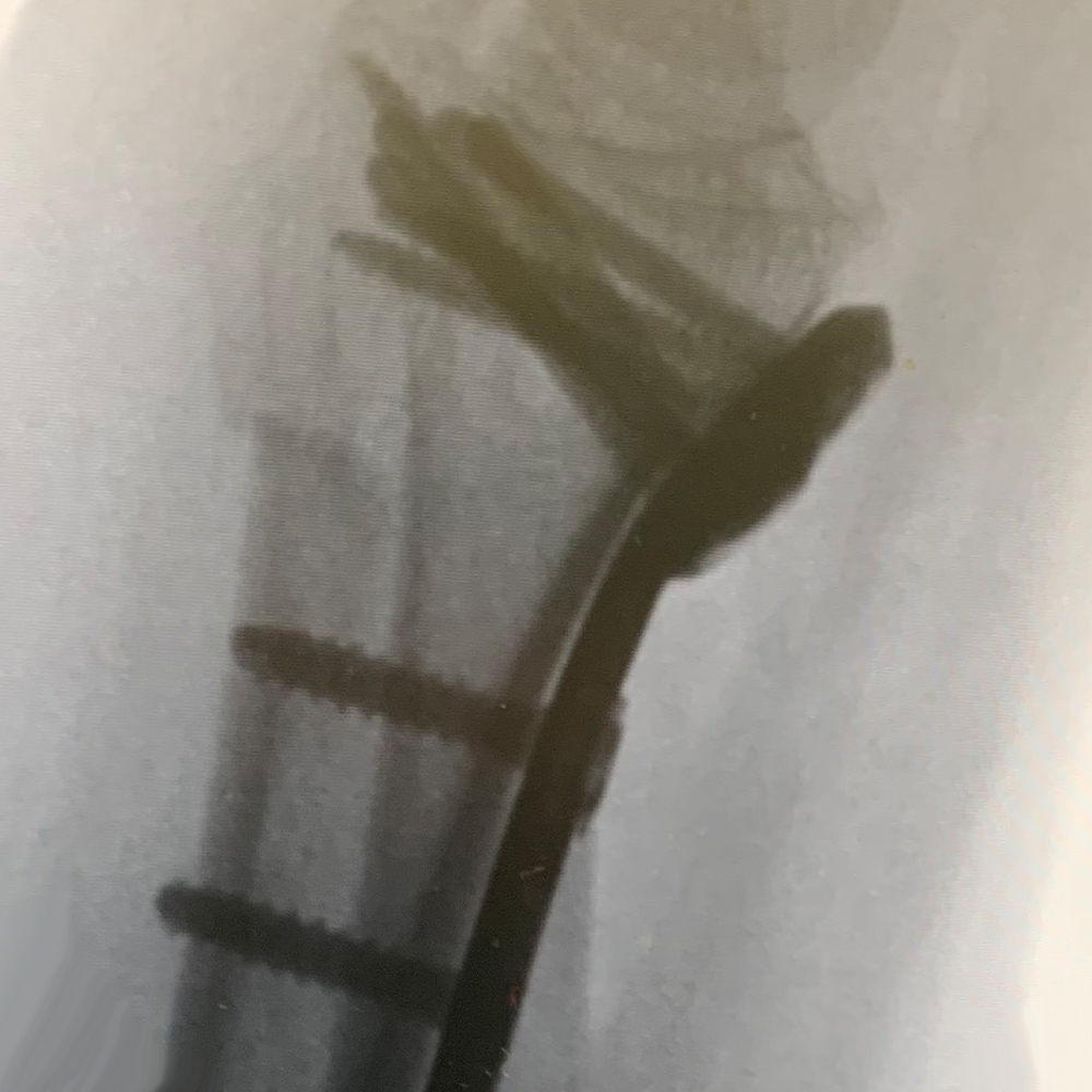 DISTAL-RADIUS---Image-2