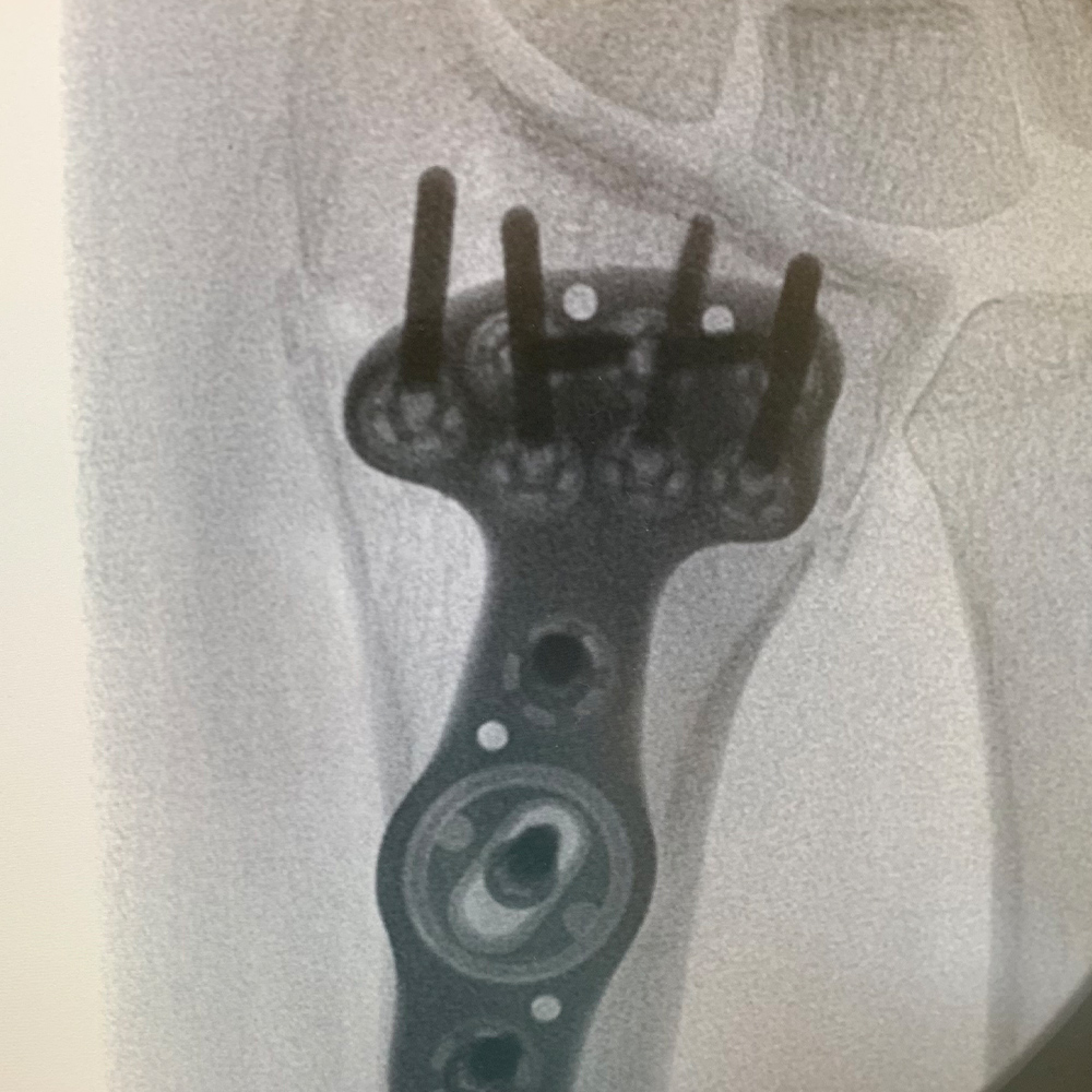 DISTAL-RADIUS---Image-3