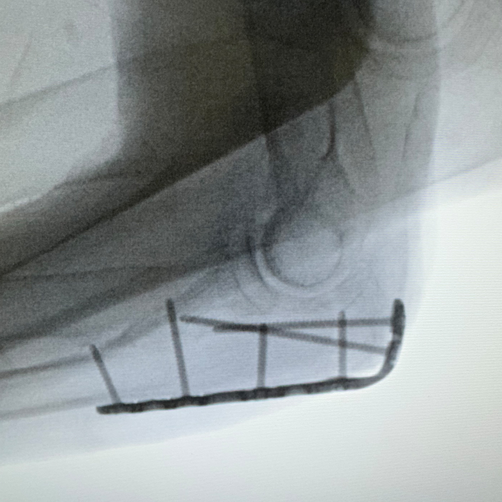 OLECRANON-SOLUTIONS---Image-2