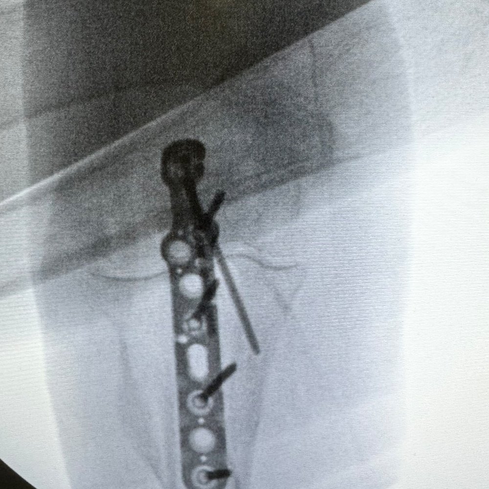 OLECRANON-SOLUTIONS---Image-3